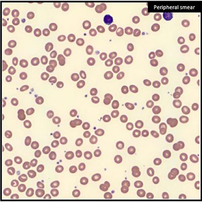 Case Report: Hematologic Recovery Following Stereotactic Ablative Radiotherapy in a Patient With Early-Stage Non-Small Cell Lung Cancer and Paraneoplastic Myelofibrosis